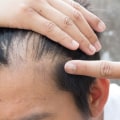 Natural Remedies for Male Pattern Baldness: A Comprehensive Guide